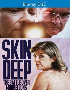 Skin Deep: The Battle Over Morgellons